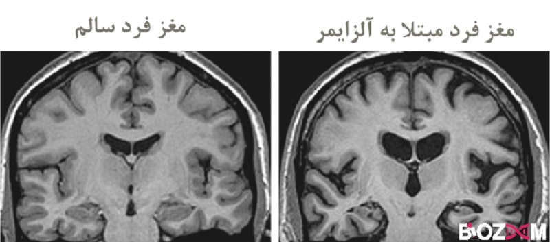 تفاوت اسکن مغز فرد مبتلا به آلزایمر و فرد سالم