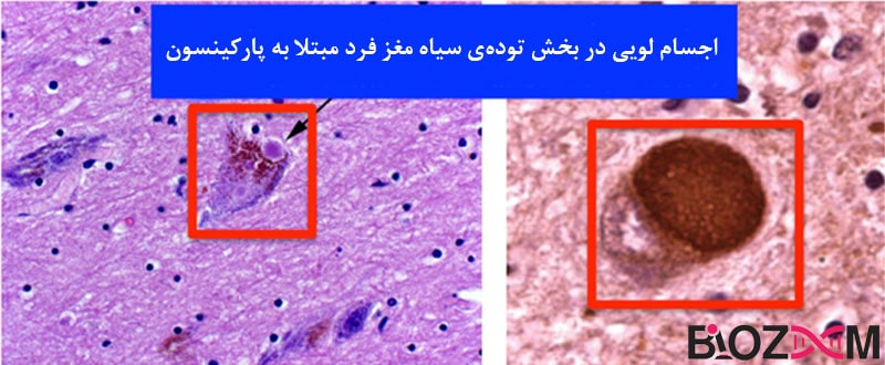 lewy-bodies-in-the-Substantia-nigra-of-people-with-Parkinson's-disease تصویری از اجسام لویی در بخش تودهی سیاه مغز فرد مبتلا به پارکینسون