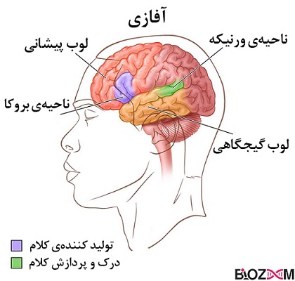 مناطقی از مغز که تحت تاثیر آفازی ورنیکه و بروکا قرار می‌گیرند