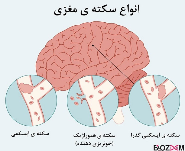 انواع سکته‌ی مغزی