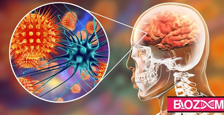 عفونت مغز با نام آبسه مغز نیز شناخته میشود