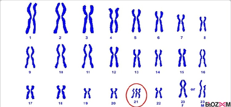 ناهنجاری عددی مربوط به بیماری سندروم داون که کروموزوم شماره 21 به‌جای دو، سه کروموزوم است.