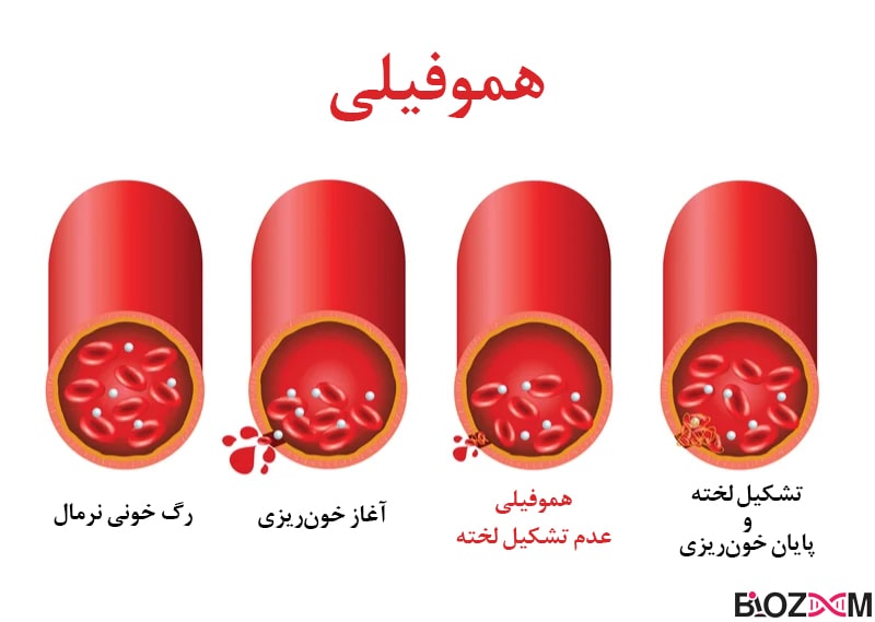 Hemophilia در بیماری هموفیلی به علت نقص در ساخت برخی از فاکتورهای انعقاد خون، در هنگام خونریزی لخته تشکیل نمیشود یا به شکلی نامناسب تشکیل میشود.