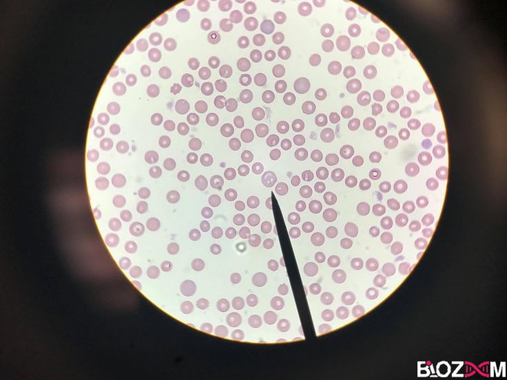 Red blood cell under the microscope گسترش خونی مربوط به گلبول های قرمز در زیر میکروسکوپ نوری