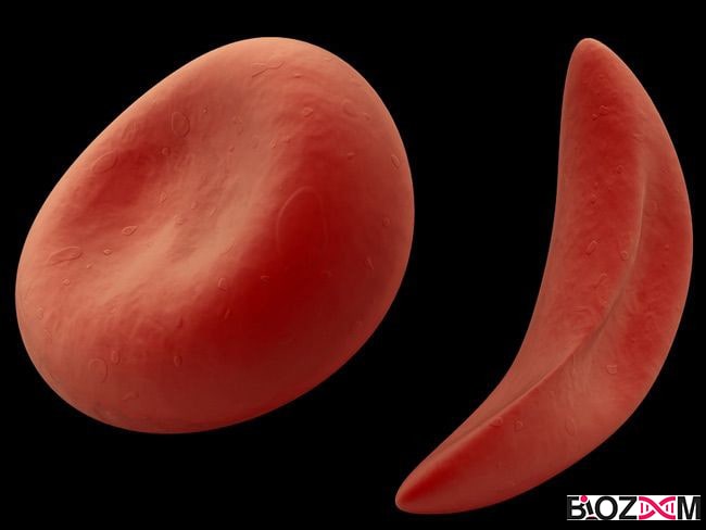 Sickle cell anemia بیماری گلبولهای سفید داسی شکل
