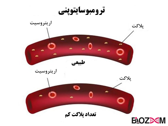 Thrombocytopenia ترومبوسایتوپنی