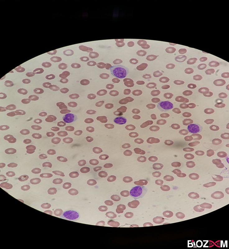 White blood cell under the microscope گسترش خونی مربوط به گلبول های سفید در زیر میکروسکوپ نوری
