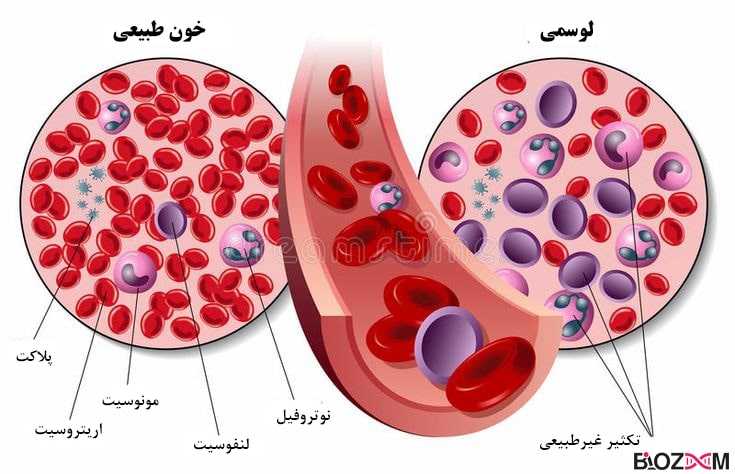 leukemia لوسمی