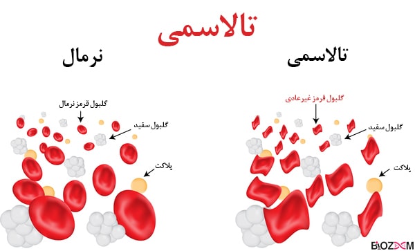 talasemia تالاسمی