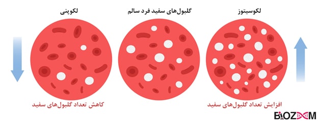 Disorders of changing the number of white blood cells تصویر اختلالات تغییر تعداد گلبول سفید خون