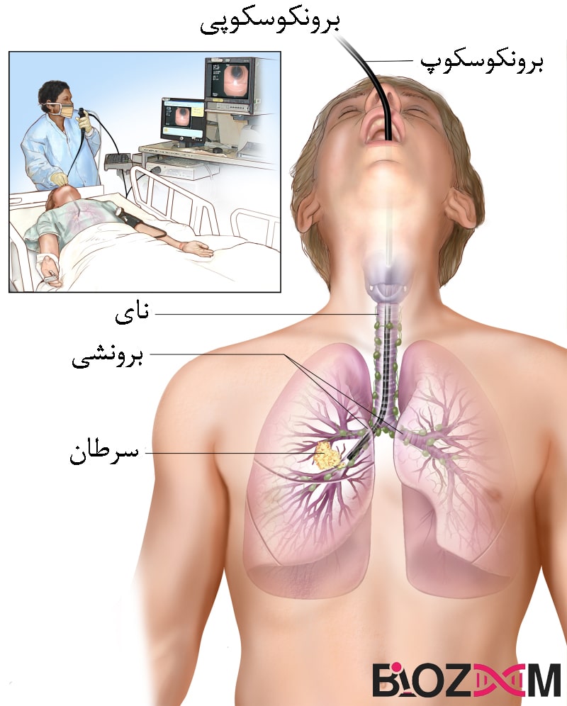 Bronchoscopy تصویر برونسکوپی