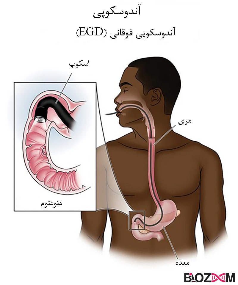 Endoscopy