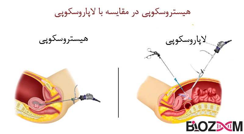 The-Difference Between Laparoscopy and Hysteroscopy Banker IVF
