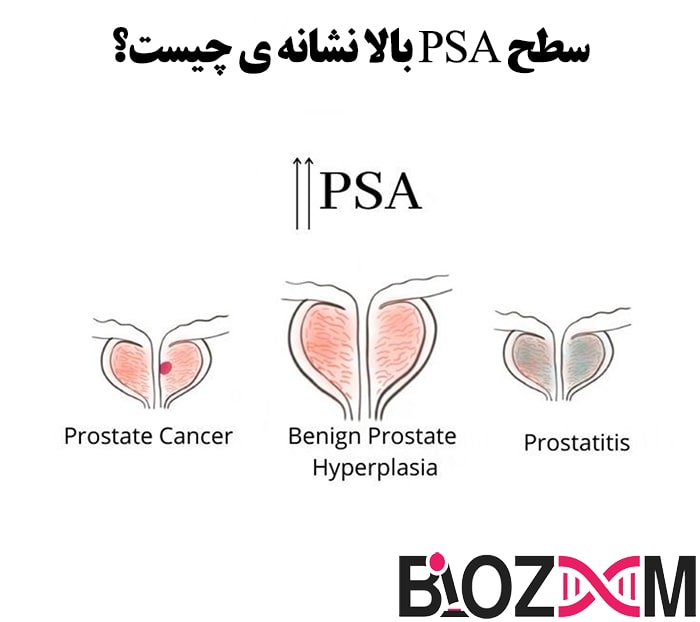 نشانه سطح بالای PSA در سرطان پروستات