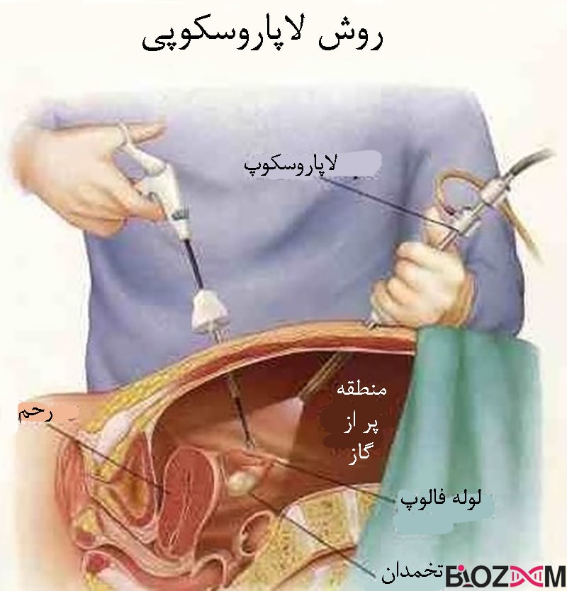 لاپاراسکوپی یک روش پیشرفته با استفاده از آندوسکوپی است