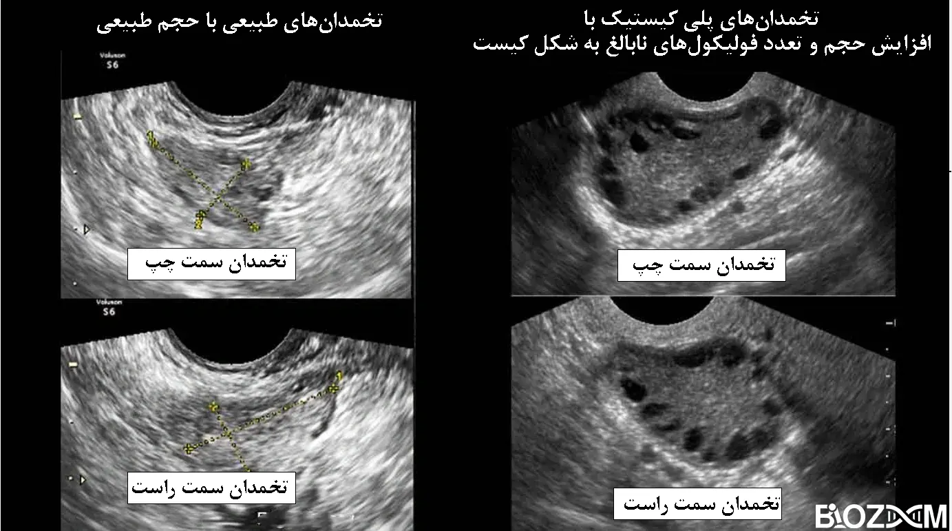 PCO and normal ovaries sonography تصویر سونوگرافی سندروم تخمدان پلی کیستیک