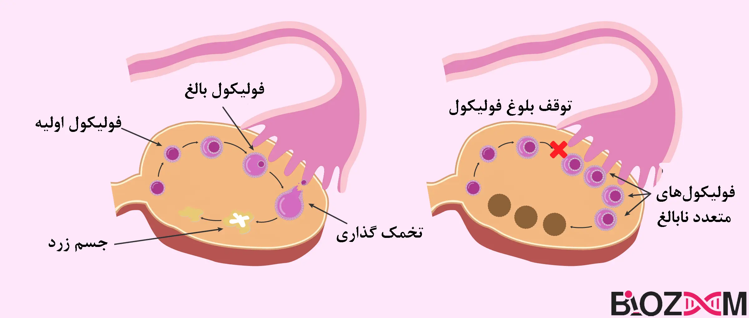 normal ovary vs polycystic ovary تصویر مقایسه تخمدان سالم با تخمدان دارای سندروم تخمدان پلی کیستیک