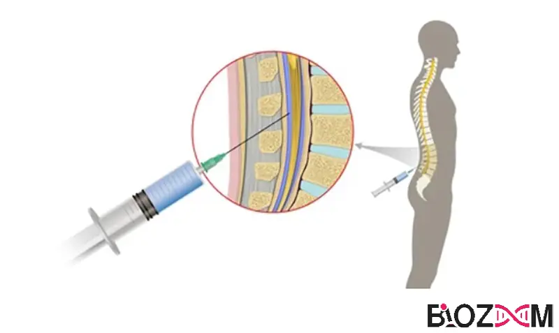 Cerebrospinal fluid extraction تصویر استخراج مایع مغزی نخاعی