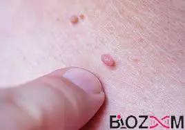 hpv زگیل تناسلی ایجاد شده توسط ویروس اچ ای وی