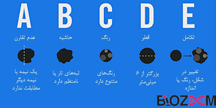 skin cancer abcde methode مراحل قانون ABCDE در سرطان پوست