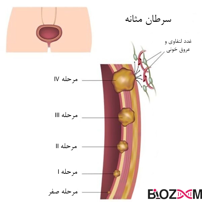 stages of bladder cancer تصویر مراحل سرطان مثانه