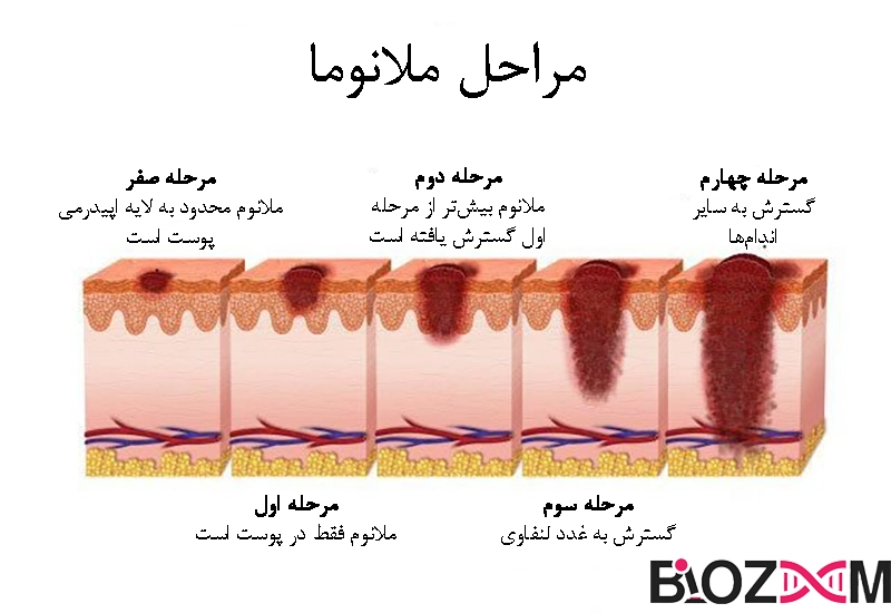 stages of skin cancer تصویر مراحل ملانوما
