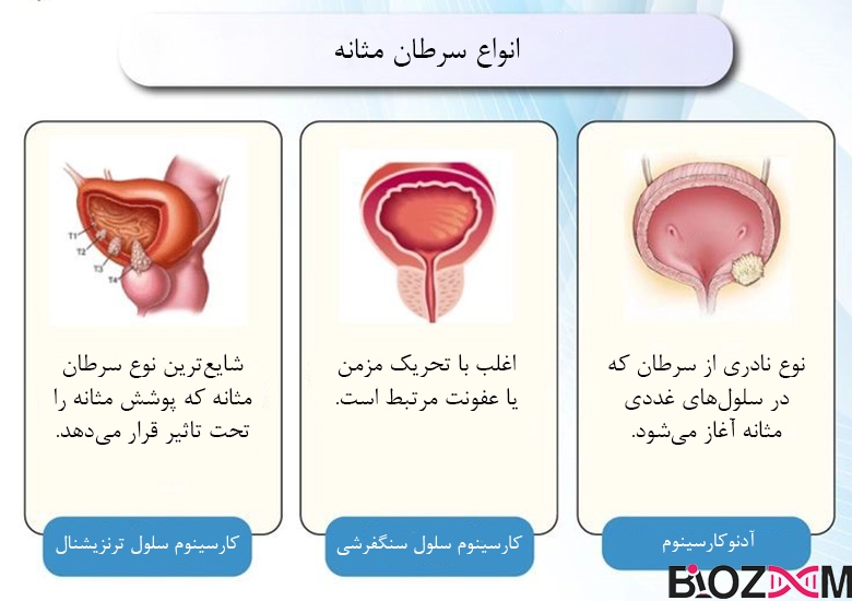 types of bladder cancer تصویری از انواع سرطان مثانه