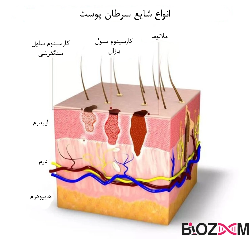 types of skin cancer شماتیکی انواع سرطان پوست در انسان