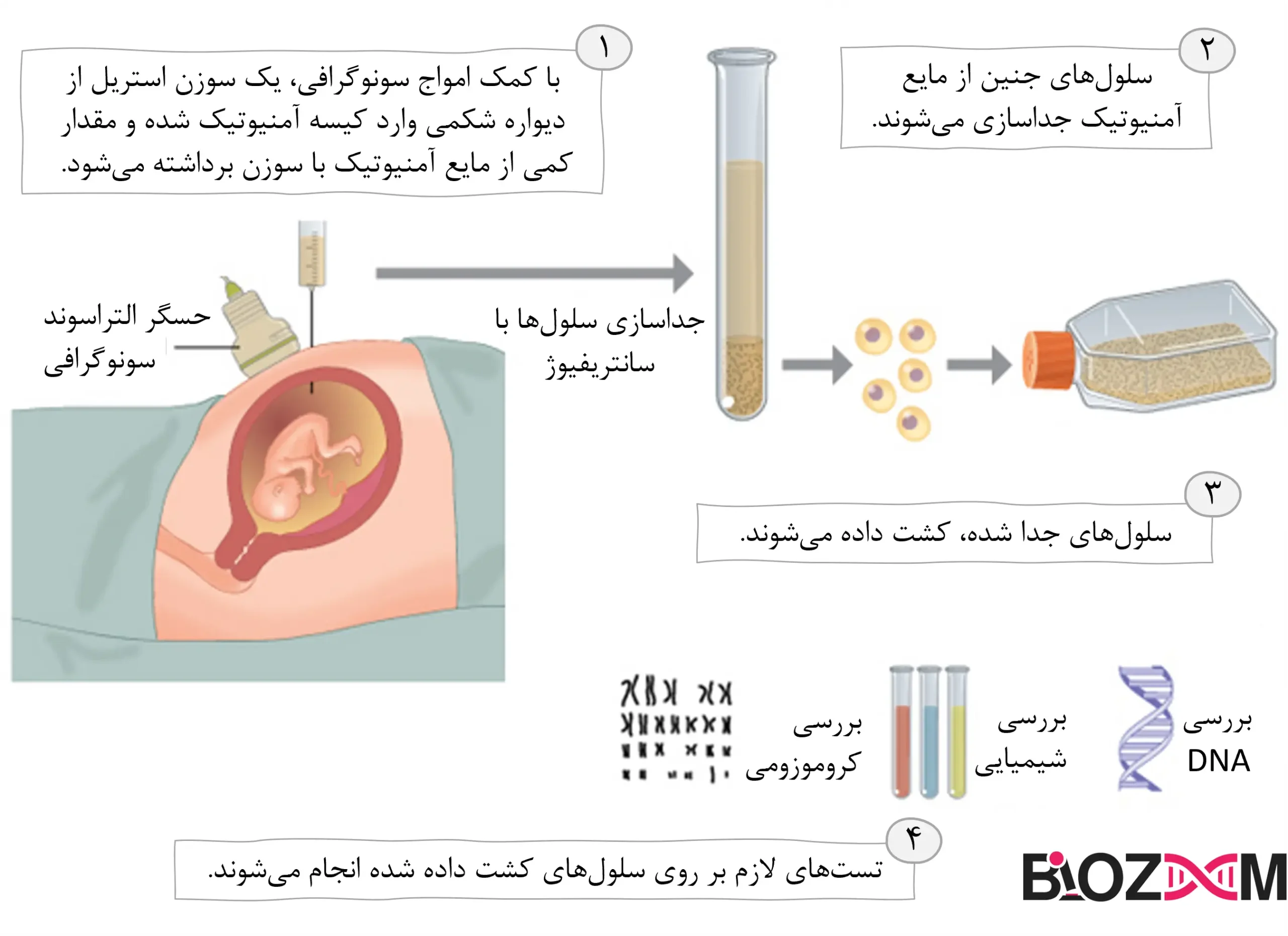 Amniocentesis steps تصویری از مراحل انجام آمنیوسنتز