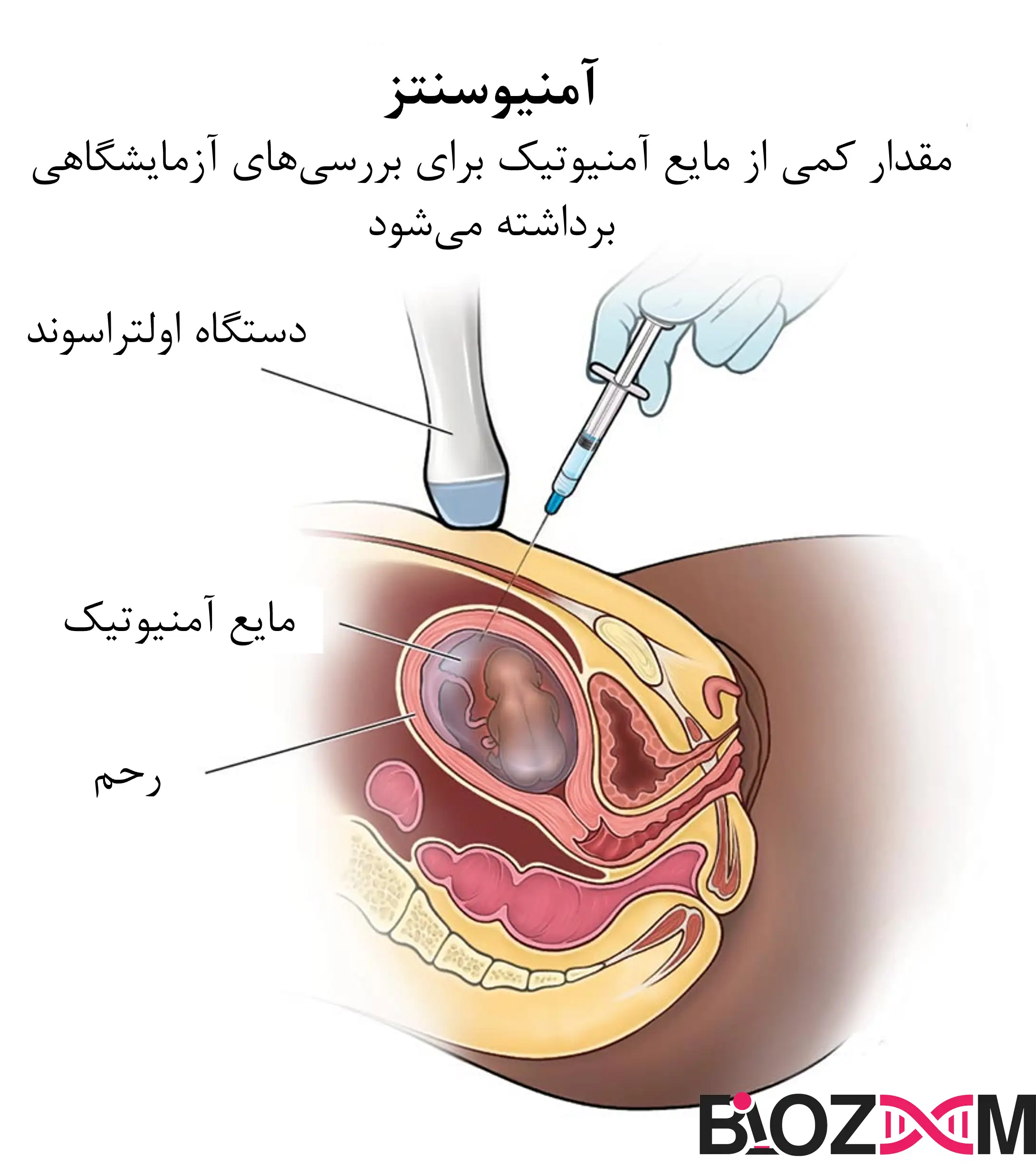 Amniocentesis process تصویر آزمایش آمنیوسنتز