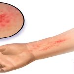 آلرژی یک واکنش دفاعی است که سیستم ایمنی در برابر آلرژن‌ها از خود نشان می‌دهد
