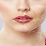 Pyruvic-acid-peel-a-promising-procedure-to-treat-acne-vulgaris-new-research